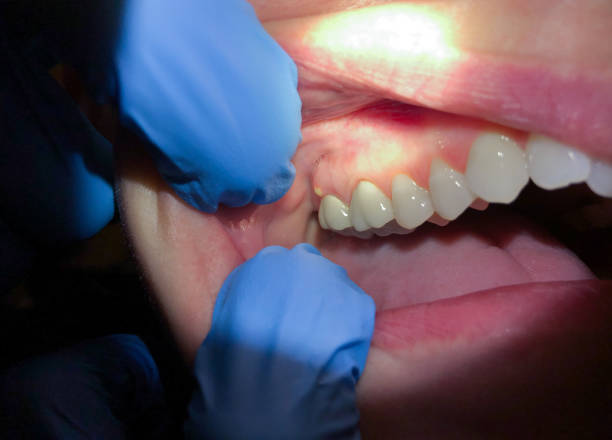 Best Emergency Dental Care for Broken or Chipped Teeth in Hiram, OH